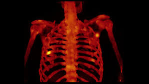 Xspect Bone