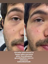 Q-Switched Nd: YAG lazer Yeni geliştirilmiş ve enerjiyi eşit dağıtan  Q-Switched Nd:YAG Lazer'ler dermiste fibroblast aktivasyonuna bağlı elastin  ve kolajeni arttırırken cilt lekelerini de azaltabilir. Q-Switched Nd:YAG  Lazer güneşe bağlı cilt lekelerini