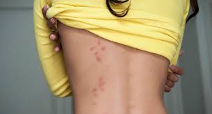 What Do Bed Bug Bites Look Like? What To Know