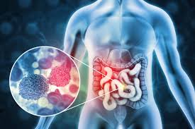 Image result for Colorectal Cancer