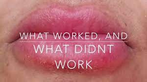 Cure A Lip Allergy Big Swollen Cracked Painful Lips What Works What Doesn T Youtube