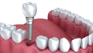 A dental implant is a metal post, usually made from titanium, that is surgically inserted into your jawbone beneath the gum and acts as an artificial root. How Much Do Dental Implants Cost In Toronto Atlas Dental Toronto