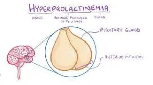 Image result for Hyperprolactinemia