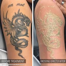 Tattoo removal has grown exponentially in melbourne, fl as the popularity of tattoos has grown and as the science of laser tattoo removal has. Naseljenci Paket Ali Paket Vzvod Laser Tattoo Removal Melbourne Jhouserconstruction Com