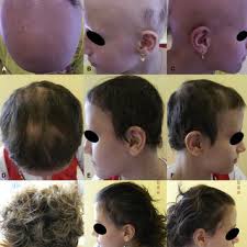 Image result for Anthralin