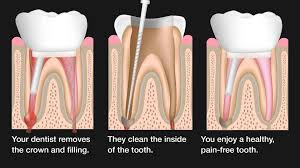 It varies, but it's usually somewhere between $400 and $1,400. Root Canal Retreatment