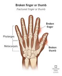Image result for Hand Fracture