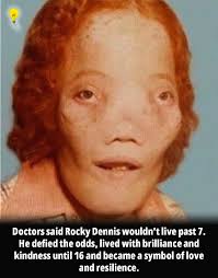 Boy with rare condition defies predictions