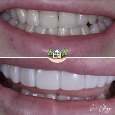 A porcelain veneer is a tooth coloured shell of porcelain bonded to the front surface of the teeth. Composite Veneers Vs Porcelain Which Is Best The Dental House