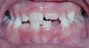 Image result for Dentition
