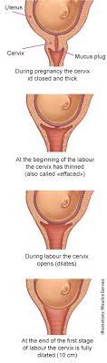 First Stage Thinning And Opening Of The Cervix From Tiny Tot To Toddler Inspq