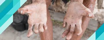 Image result for Leprosy