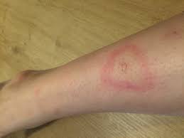 Symptoms of ringworm vary based on the infected body part. Animal To Human Spreading Ringworm Look Alike Dermatology Forums Patient