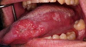 Image result for papillomavirus tongue)