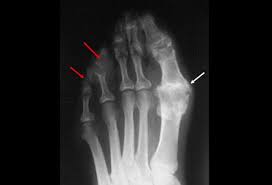 Image result for XRay Changes in Rheumatic Conditions