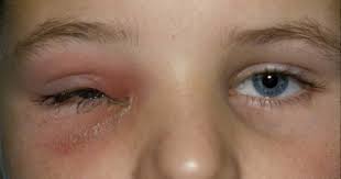 Adanya protein dalam urine menunjukkan gejala awal filter ginjal telah rusak. 7 Jenis Sakit Mata Pada Anak Yang Umum Dialami Popmama Com