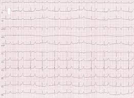 Long Qt Syndrom Fokus Ekg