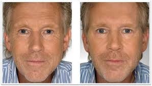 You'll have a consultation and a treatment plan will. Injectables Before After Injector 5280