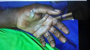 Image result for Electrical Injury