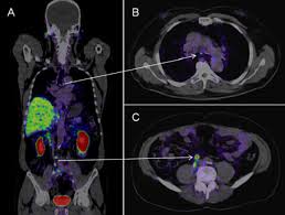 The scan will take 20 to 40 minutes. Psma Pet Ct Accurately Detects Prostate Cancer Spread National Cancer Institute