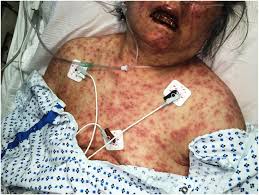 This is a very serious, rare condition where the mucous membranes. Allopurinol Induced Stevens Johnson Syndrome The American Journal Of The Medical Sciences