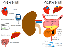 Image result for Postrenal Failure