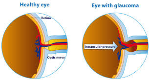 Find specific results from your searches. Glaucoma Types And Treatment News Updates Disabled World