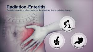 Image result for Radiation Colitis