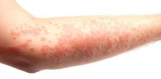How To Get Rid Of Hives Home Remedies For Hives Hives Remedies Rashes Remedies