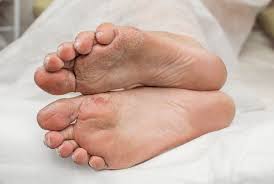Image result for diabetic toes