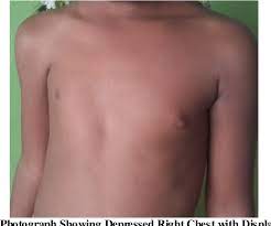 Poland's syndrome is a rare congenital condition classically characterized by partial or complete absence of chest muscles on one side of the body and usually webbing of the poland's syndrome most often affects the right side of the body and occurs more frequently in males than in females. Pdf A Case Of Poland Syndrome In A Young Female Child Without Additional Malformation Semantic Scholar