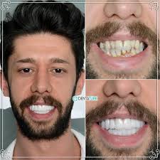➡️🇹🇷 İstanbul'da yaşayan hastamıza komple zirkonyum kaplama yaparak  Estetik Gülüş Tasarımını 5 günde tamamladık. 👄Bizi tercih eden kıymetli  hastalarımızı hayallerindeki gülüşe kavuşturuyoruz ➡️Doğru analizler  sağlıklı tedaviye ulaştırır. Değerli ...