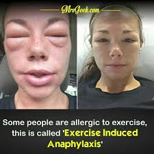 Image result for Exercise-Induced Anaphylaxis