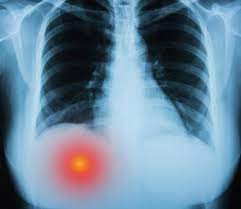 Learn here what might cause rib cage pain, and the symptoms of various conditions, including lung cancer. Here S What It Means If You Have Pain Under You Right Rib Cage