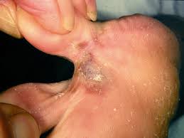 Solve your problem quick & easy with online consultation. Melanoma Of The Foot Bpj65 December 2014