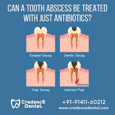 Can A Tooth Abscess Be Treated With Just Antibiotics