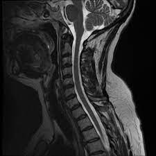 A cervical mri may also be done before spinal surgery. Normal Cervical And Thoracic Spine Mri Radiology Case Radiopaedia Org