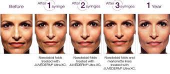 Each syringe of juvederm is one cc. Juvederm Houston Dermal Fillers Sugar Land Injectable Fillers Katy Tx