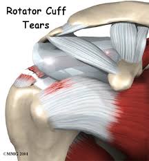 Early passive range of motion is highly beneficial to enhance circulation within the joint to promote healing. Physical Therapy In Dothan For Shoulder Rotator Cuff Tears