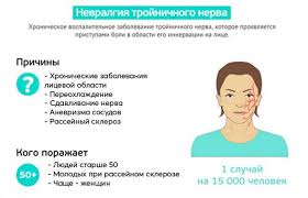 как лечить воспаление тройничного лицевого нерва в домашних условиях Zashemlenie Licevogo Nerva Simptomy Lechenie Profilaktika