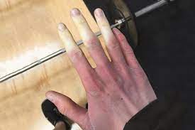 Auslöser sind kälte oder stress cv: Drug Induced Raynaud S Phenomenon Probably Underestimated The Pharmaceutical Journal