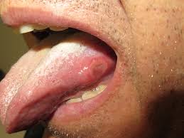 Image result for mouth ulcer on tongue)