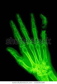 Manus X Ray Anatomy Radiology Radiographic Stock Photo Edit Now 1459397288