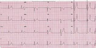 Whats A Normal Heart Rate