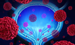 Lower back pain on 1 side of the body. Fda Breakthrough Therapy Granted To Bladder Cancer Treatment