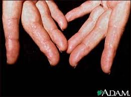 And might they be something serious? Amyloidosis Of The Fingers Medlineplus Medical Encyclopedia Image