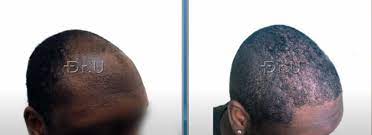 Forum discussions, blogs and sharing since 1999 created by and for patients! Video Hair Transplant For A Young 20 Year Old Black Male