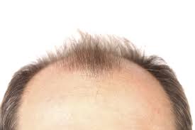 Most commonly, scalp itchiness is the result of dandruff, but again you should always consult your doctor to ensure it isn't something more serious. Itchy Scalp Dandruff Symptoms Causes Treatments Diagnosis