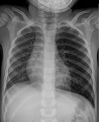 Aspirasjon av fremmedlegemer til lungene kan være vanskelig å diagnostisere. Fremmedlegemer Aspirasjon Foreign Body Aspiration Qaz Wiki