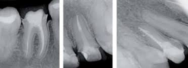 La mucormicosis rinocerebral es una infección oportunista infrecuente, con mayor prevalencia en inmunodeprimidos. Paciente Endodontico Con Mucormicosis Rinocerebral Reporte De Un Caso Sciencedirect